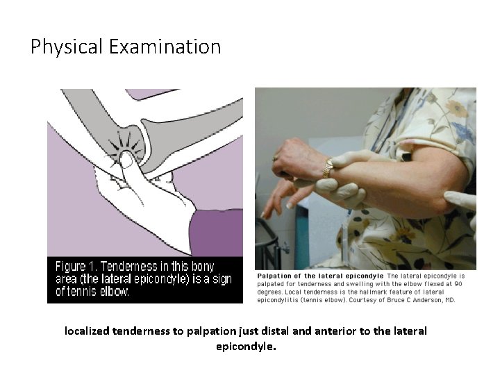 Physical Examination localized tenderness to palpation just distal and anterior to the lateral epicondyle.