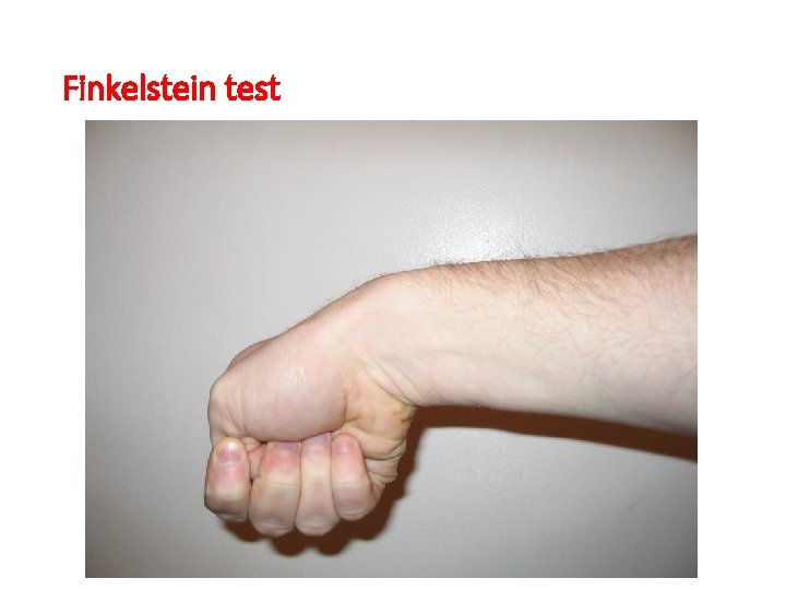 Finkelstein test 