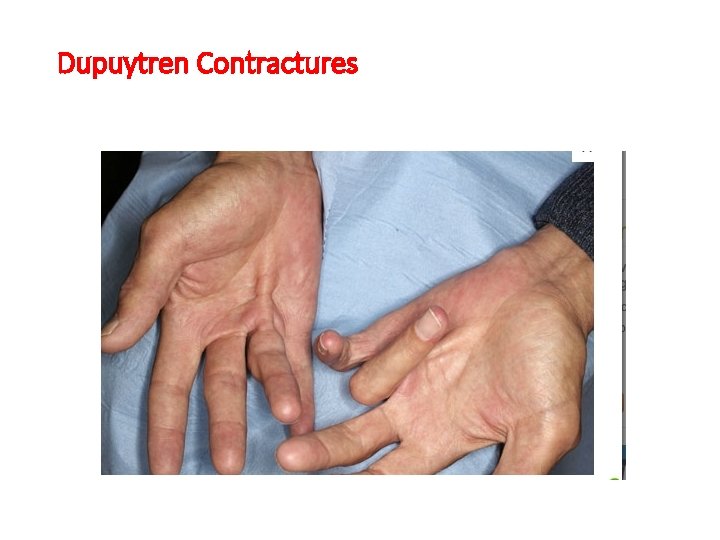 Dupuytren Contractures 