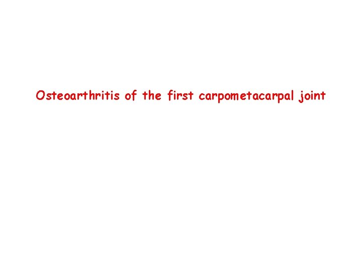 Osteoarthritis of the first carpometacarpal joint 