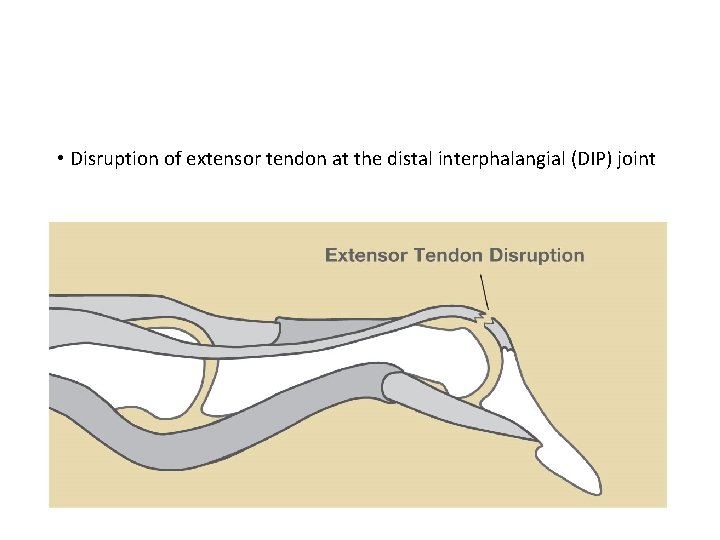  • Disruption of extensor tendon at the distal interphalangial (DIP) joint 