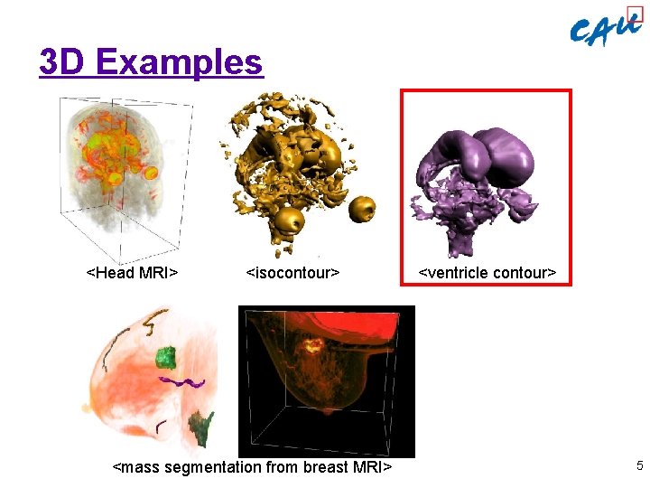 3 D Examples <Head MRI> <isocontour> <mass segmentation from breast MRI> <ventricle contour> 5