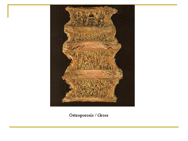 Osteoporosis / Gross 