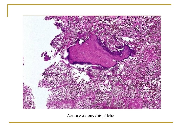 Acute osteomyelitis / Mic 