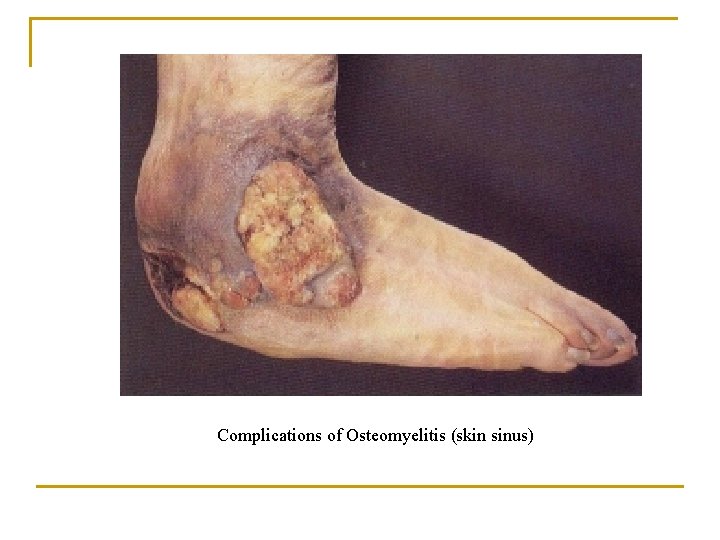 Complications of Osteomyelitis (skin sinus) 