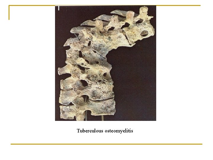 Tuberculous osteomyelitis 