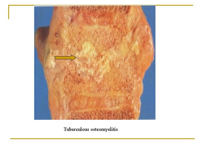 Tuberculous osteomyelitis 