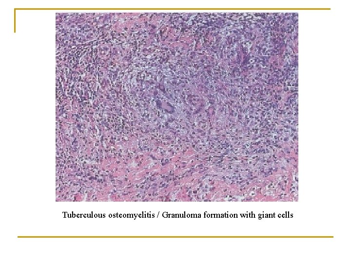 Tuberculous osteomyelitis / Granuloma formation with giant cells 