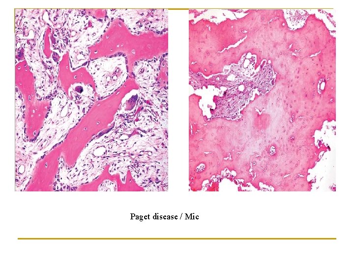 Paget disease / Mic 