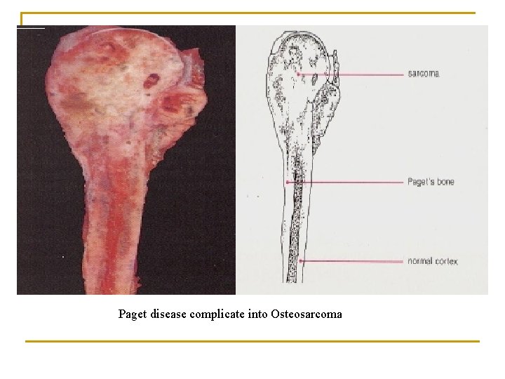 Paget disease complicate into Osteosarcoma 