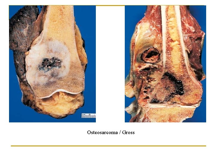 Osteosarcoma / Gross 