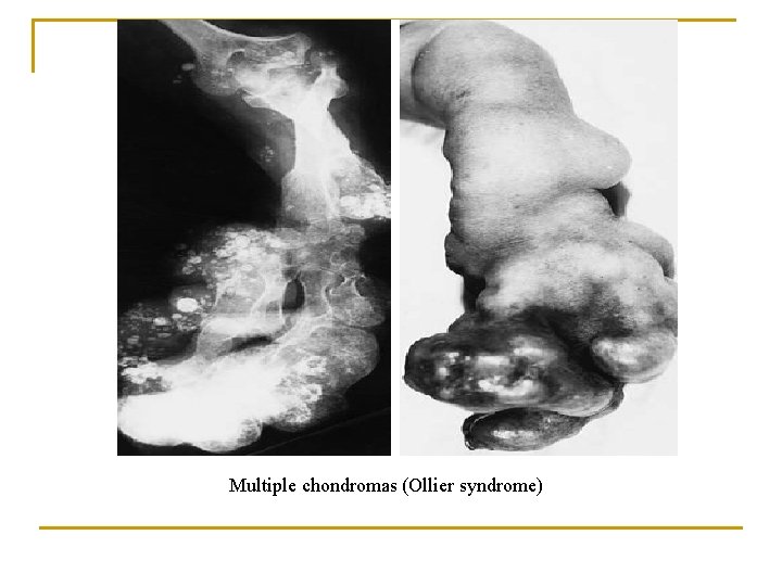 Multiple chondromas (Ollier syndrome) 