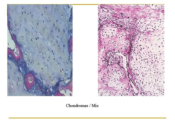 Chondromas / Mic 