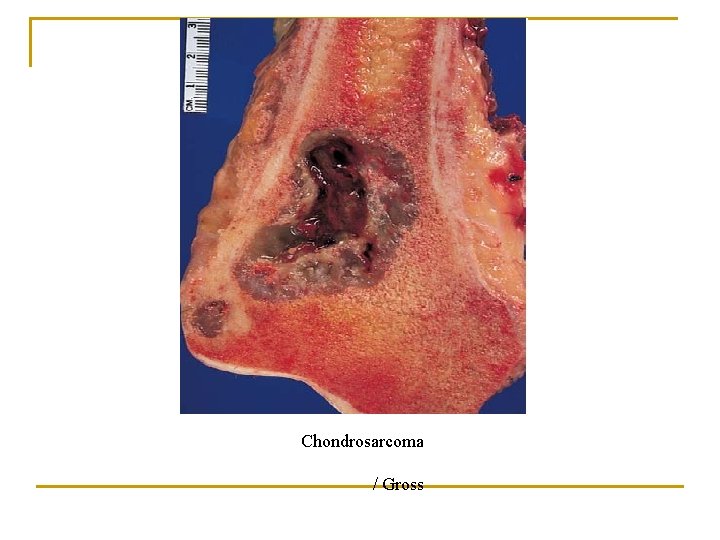 Chondrosarcoma / Gross 