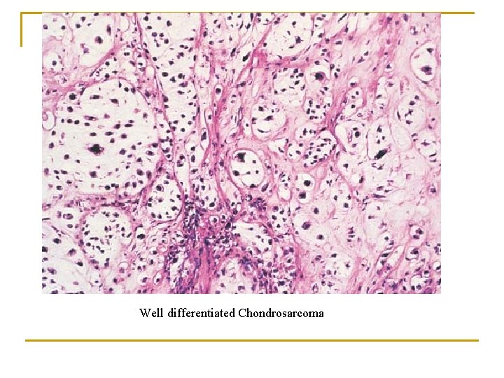 Well differentiated Chondrosarcoma 