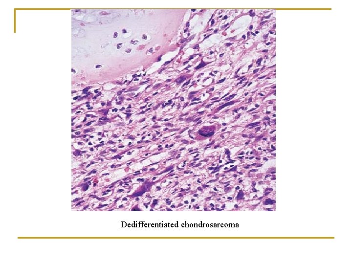 Dedifferentiated chondrosarcoma 
