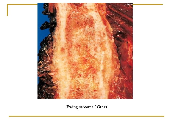 Ewing sarcoma / Gross 