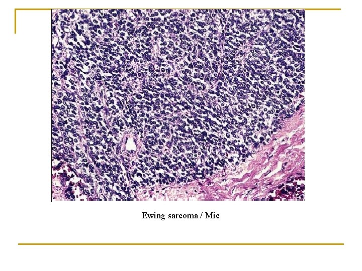 Ewing sarcoma / Mic 