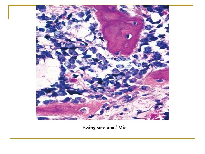 Ewing sarcoma / Mic 