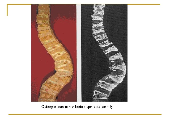 Osteogenesis imperfecta / spine deformity 