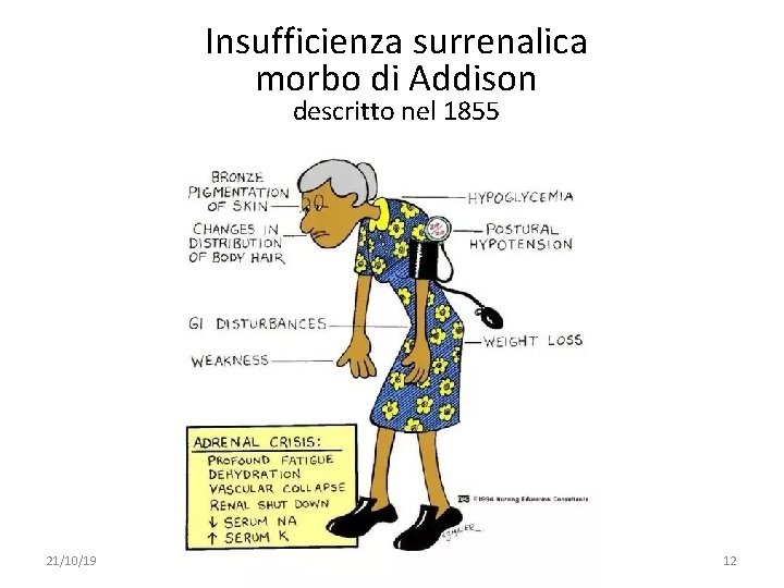 Insufficienza surrenalica morbo di Addison descritto nel 1855 21/10/19 091 FA - BIOCHIMICA APPLICATA