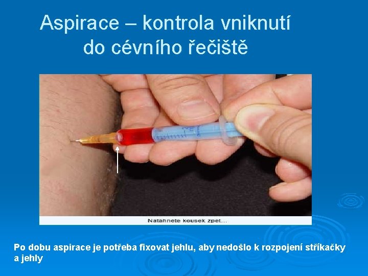 Aspirace – kontrola vniknutí do cévního řečiště Po dobu aspirace je potřeba fixovat jehlu,