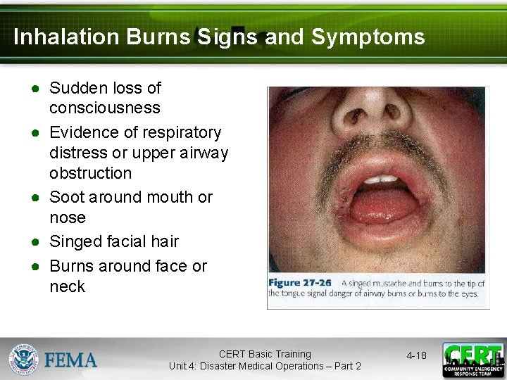 Inhalation Burns Signs and Symptoms ● Sudden loss of consciousness ● Evidence of respiratory