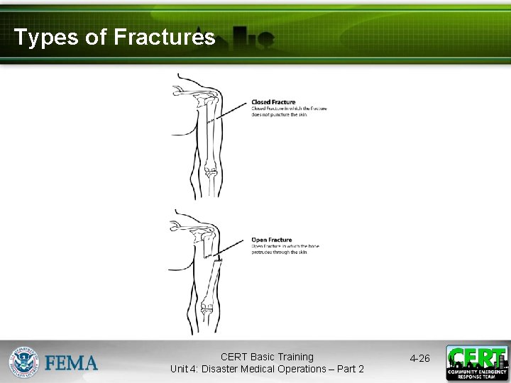 Types of Fractures CERT Basic Training Unit 4: Disaster Medical Operations – Part 2