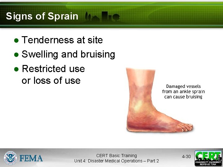 Signs of Sprain ● Tenderness at site ● Swelling and bruising ● Restricted use