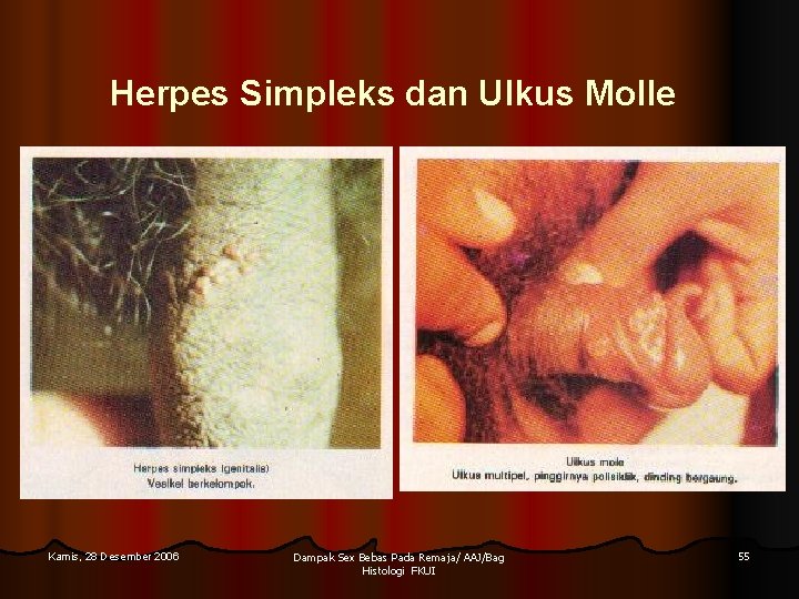 Herpes Simpleks dan Ulkus Molle Kamis, 28 Desember 2006 Dampak Sex Bebas Pada Remaja/