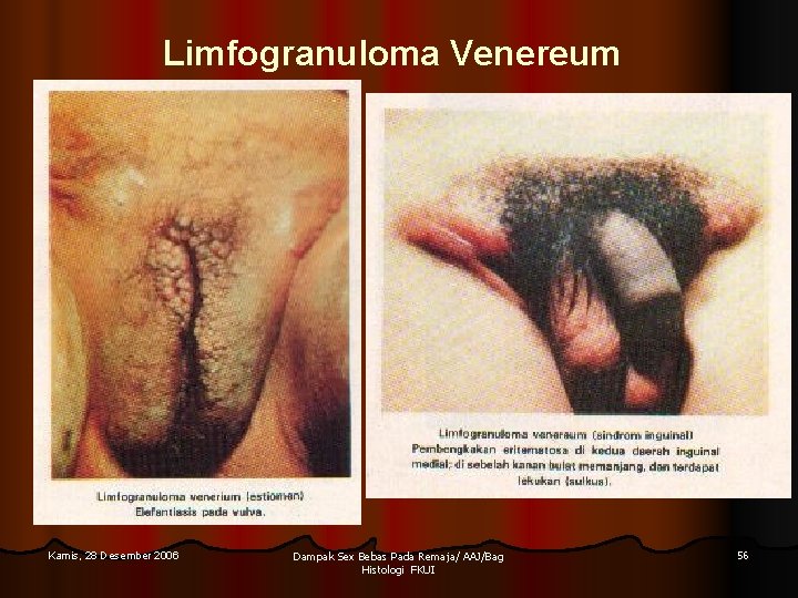 Limfogranuloma Venereum Kamis, 28 Desember 2006 Dampak Sex Bebas Pada Remaja/ AAJ/Bag Histologi FKUI