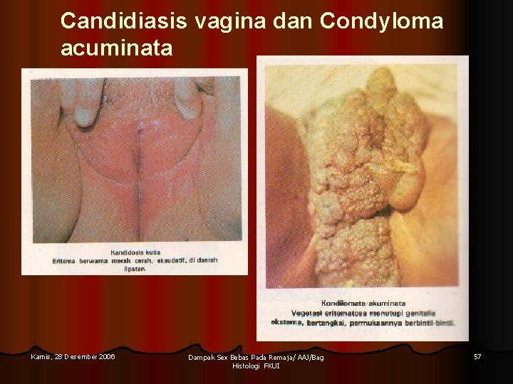 Candidiasis vagina dan Condyloma acuminata Kamis, 28 Desember 2006 Dampak Sex Bebas Pada Remaja/ Candidiasis vagina dan Condyloma acuminata Kamis, 28 Desember 2006 Dampak Sex Bebas Pada Remaja/