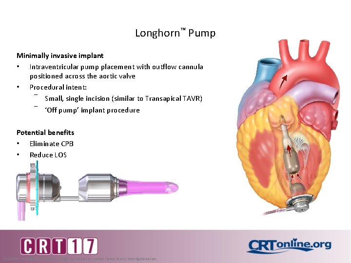 Longhorn™ Pump Minimally invasive implant • Intraventricular pump placement with outflow cannula positioned across