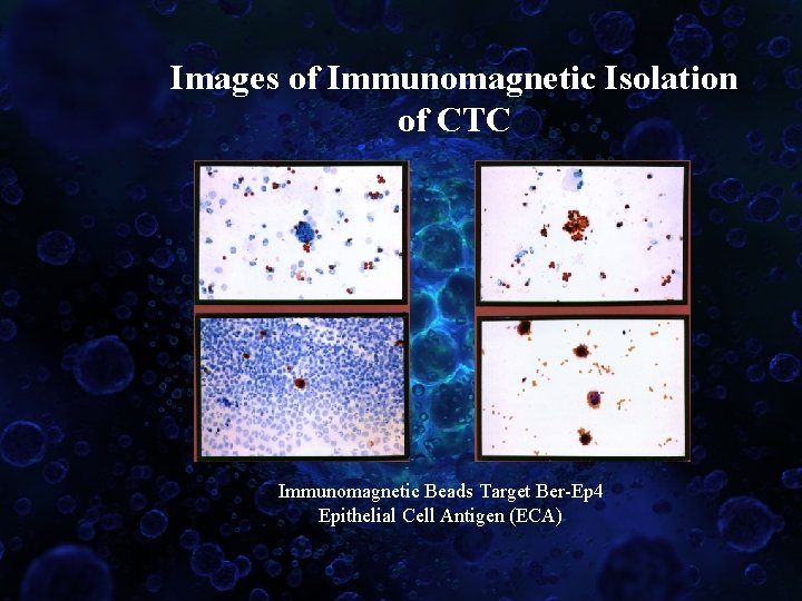 Images of Immunomagnetic Isolation of CTC Immunomagnetic Beads Target Ber-Ep 4 Epithelial Cell Antigen