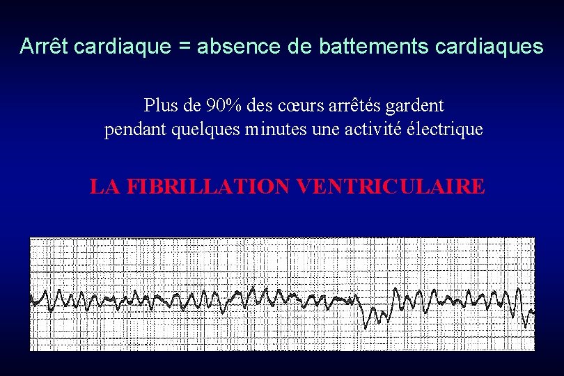 Arrêt cardiaque = absence de battements cardiaques Plus de 90% des cœurs arrêtés gardent