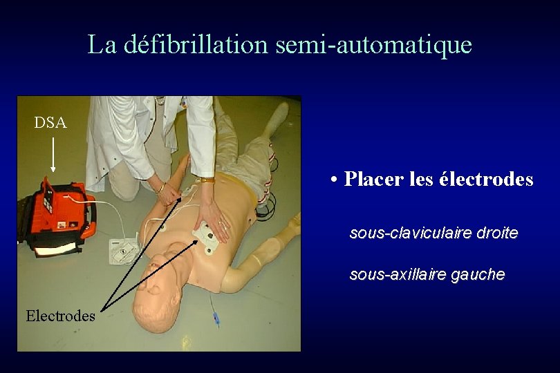 La défibrillation semi-automatique DSA • Placer les électrodes sous-claviculaire droite sous-axillaire gauche Electrodes 