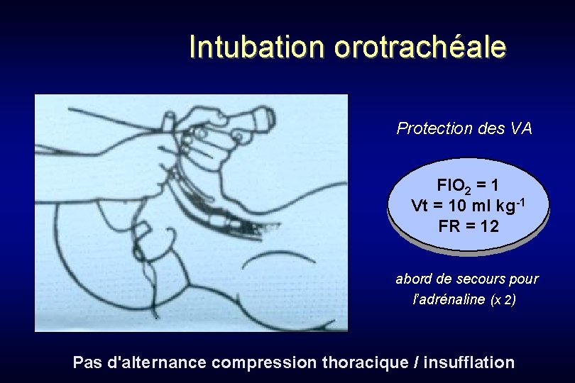 Intubation orotrachéale Protection des VA FIO 2 = 1 Vt = 10 ml kg-1