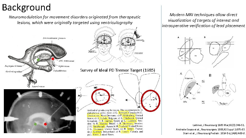 Background Neuromodulation for movement disorders originated from therapeutic lesions, which were originally targeted using
