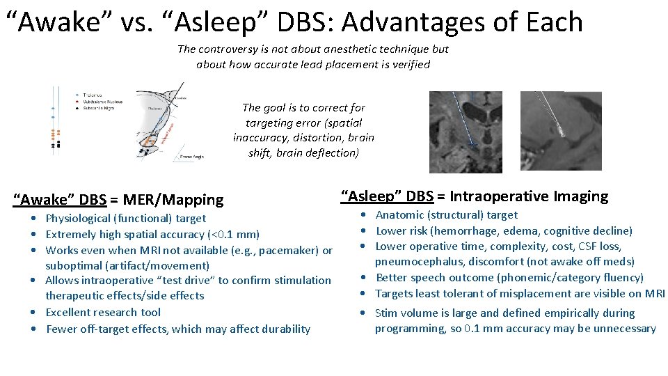 “Awake” vs. “Asleep” DBS: Advantages of Each The controversy is not about anesthetic technique