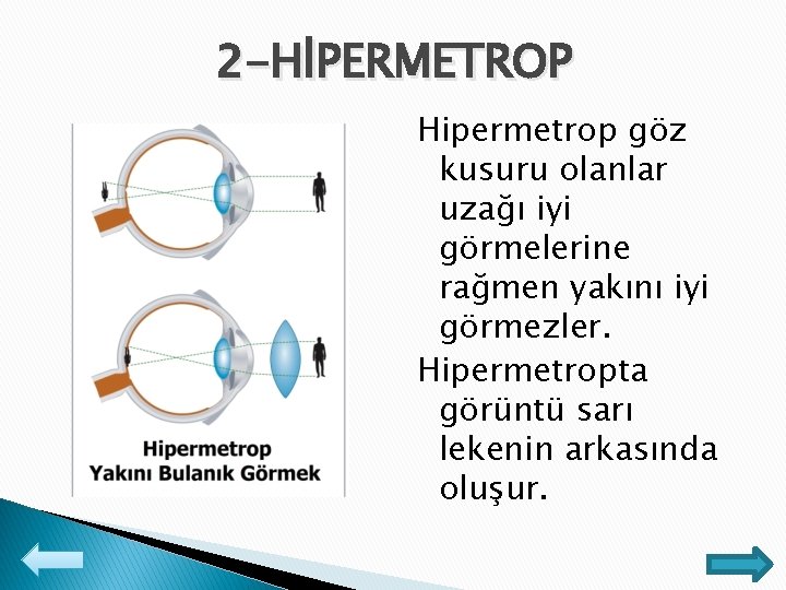 2 -HİPERMETROP Hipermetrop göz kusuru olanlar uzağı iyi görmelerine rağmen yakını iyi görmezler. Hipermetropta