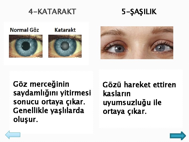 4 -KATARAKT 5 -ŞAŞILIK Göz merceğinin saydamlığını yitirmesi sonucu ortaya çıkar. Genellikle yaşlılarda oluşur.