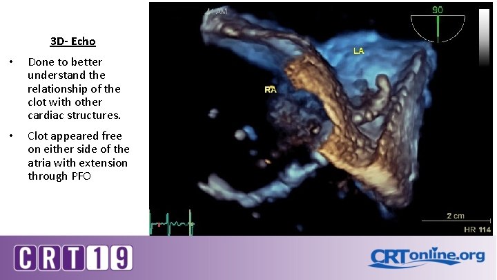 3 D- Echo • Done to better understand the relationship of the clot with