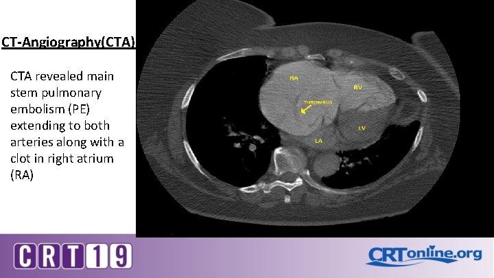 CT-Angiography(CTA) CTA revealed main stem pulmonary embolism (PE) extending to both arteries along with