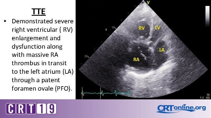 TTE • Demonstrated severe right ventricular ( RV) enlargement and dysfunction along with massive