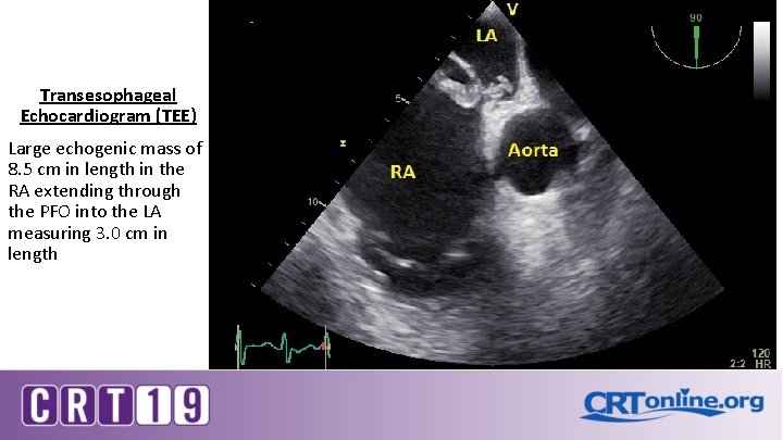 Transesophageal Echocardiogram (TEE) Large echogenic mass of 8. 5 cm in length in the