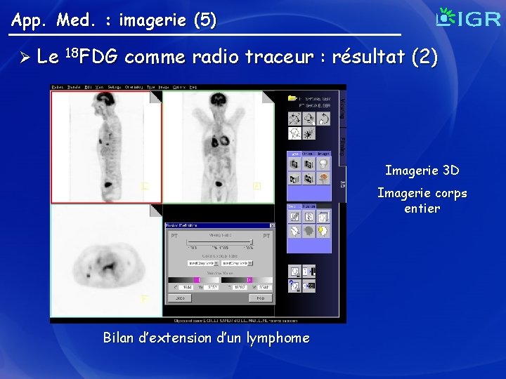 App. Med. : imagerie (5) Ø Le 18 FDG comme radio traceur : résultat