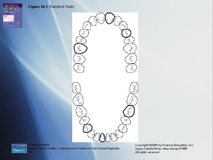 Figure 10 -1. Ramjford Teeth Christine Nathe Dental Public Health: Contemporary Practice for the