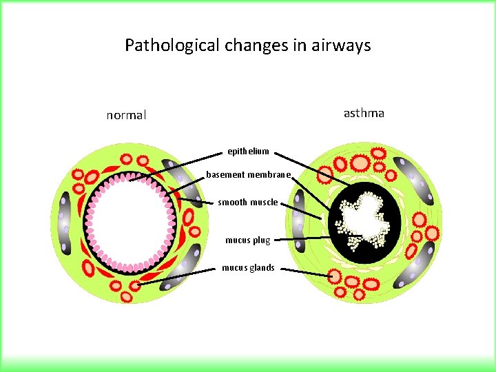 Pathological changes in airways asthma normal epithelium basement membrane smooth muscle mucus plug mucus