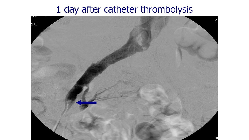 1 day after catheter thrombolysis 