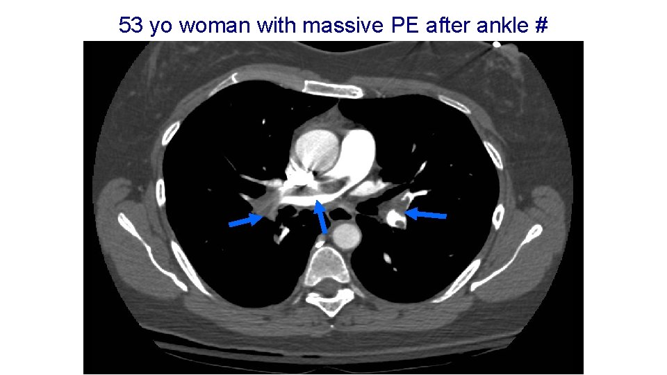 53 yo woman with massive PE after ankle # 